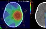 质子疗法是治疗脑癌儿童的灵丹妙药吗?