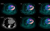 通过更低的<font color=red>放射性示踪剂</font>剂量实现更安全的心脏扫描