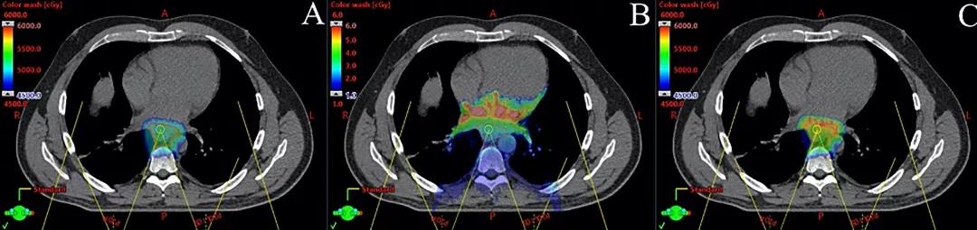 图2. 应用后斜野笔形束扫描质子治疗远端食管癌，5000 cGy/25f的蒙特卡罗剂量计算。(A)以cGy表示物理剂量，(B)以keV/mm表示线性能量转移(LET)， (C)包含物理剂量和LET的模拟生物剂量。注意，高LET区位于心脏靶区远端。