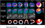 SNMMI年度图像：新的生物标记预测心脏病发作后心脏重塑的严重程度 