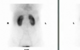 诊断婴幼儿尿路感染，核医学(DMSA)有妙招