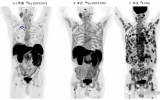 武萍、徐丽：18F-FDG 和68Ga-DOTATATE PET/CT在转移性胰腺神经内分泌肿瘤“超级影像”