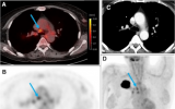 PET AI模型改善肺癌分期