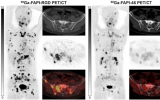 研究: Ga-68 FAPI-RGD在癌症成像中具有广阔的应用前景
